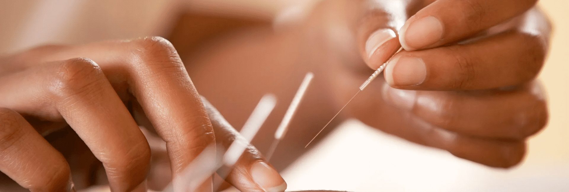 Community acupuncture consultation in London clinic